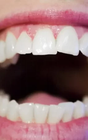 Maintaining Oral Hygiene During Orthodontic Treatment Tips for a Healthy Smile